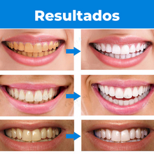 Carregar imagem no visualizador da galeria, Fora de estoque dente